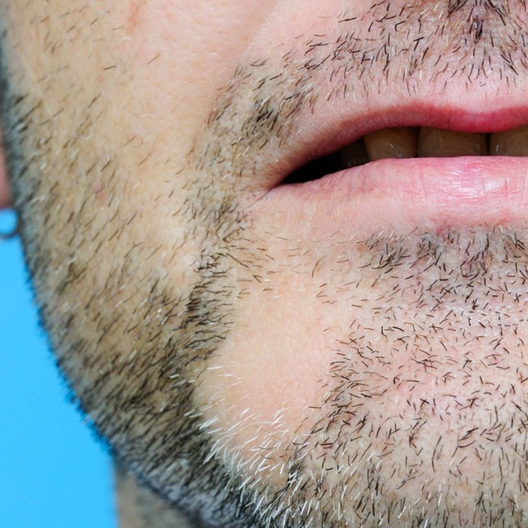 ¿Se te cae el pelo? ¡De la barba! Atento a estos consejos