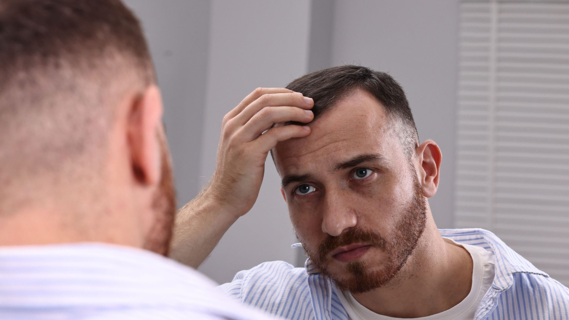 La alopecia es la mayor preocupación estética del hombre