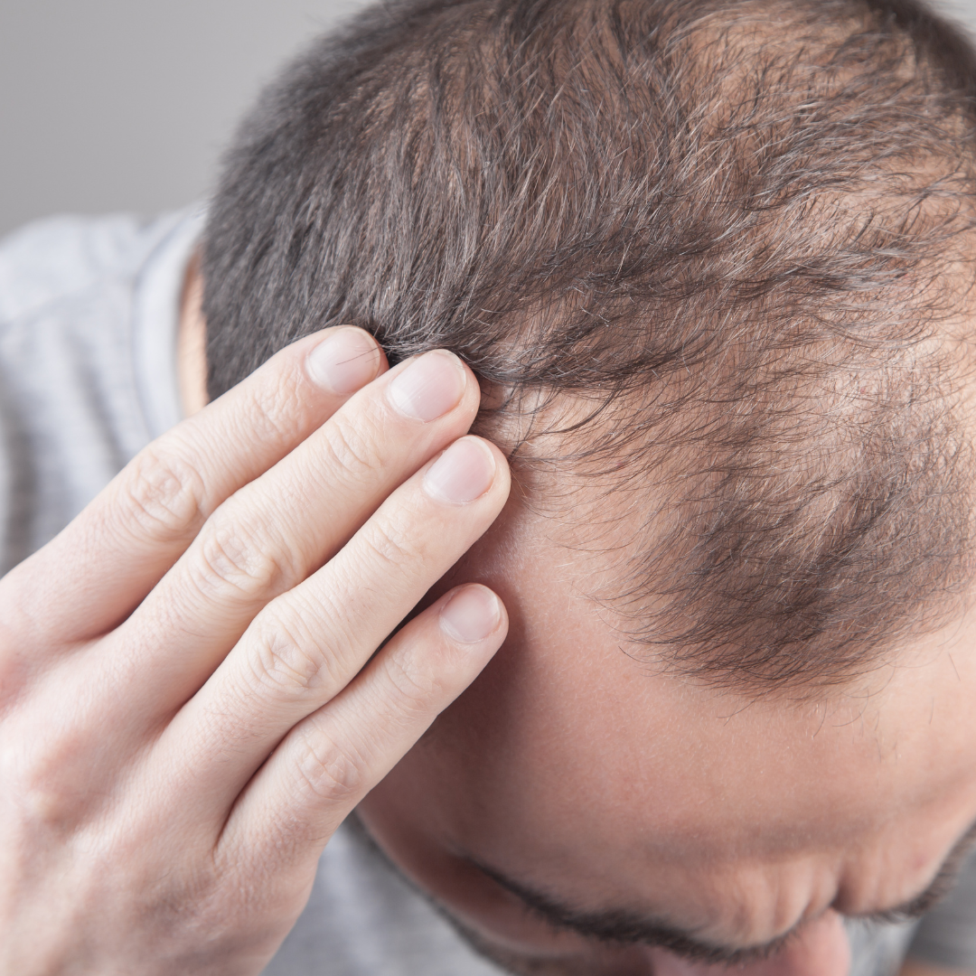 Redensyl, la revolución para la caída del cabello